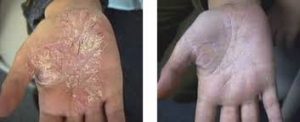 بیماری پوستی صدف (پسوریازیس):علت و درمان